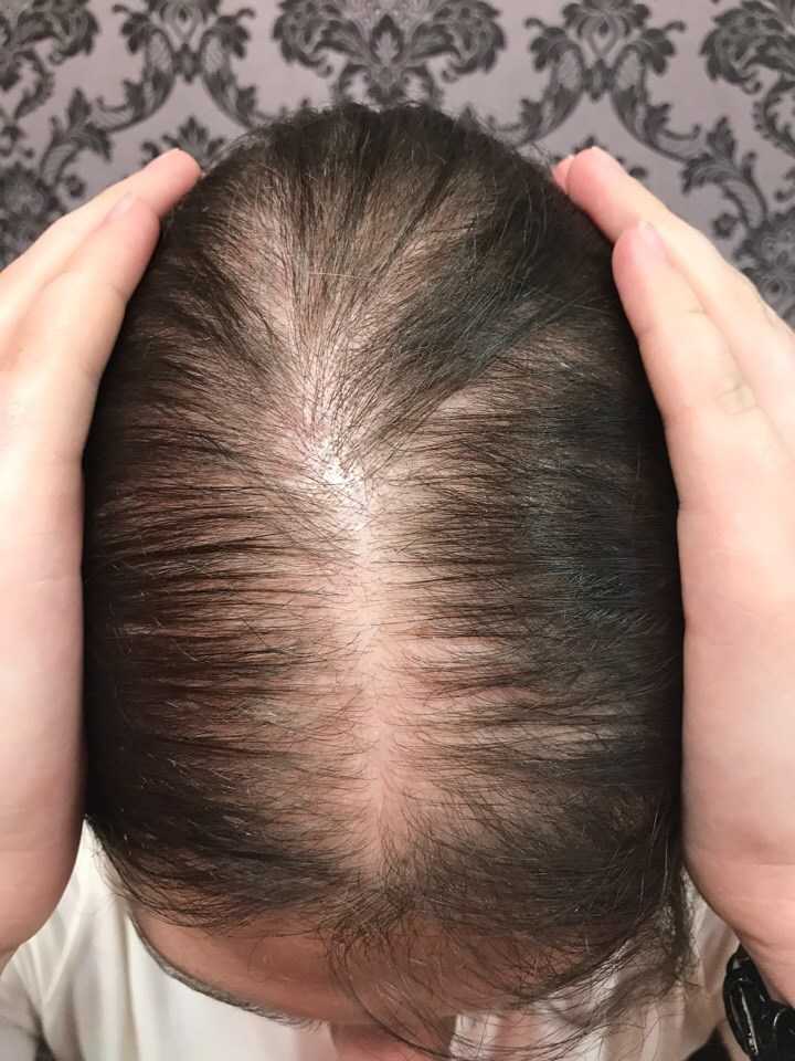 Выпадение Волос После Диеты