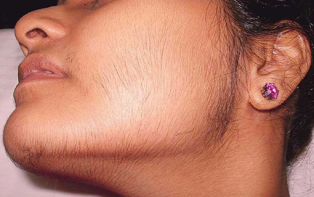 Повышенная волосатость у брюнетки