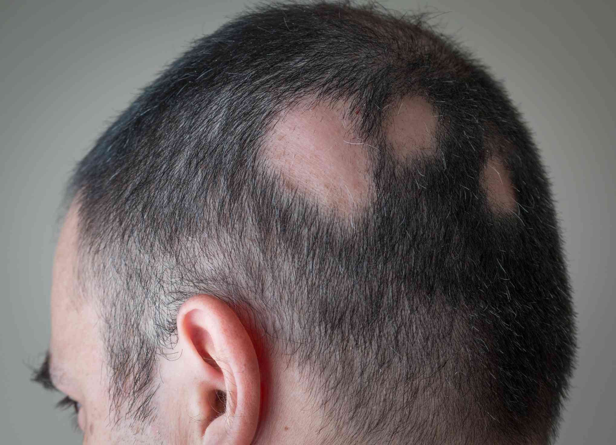 Как остановить выпадение волос у мужчин: 6 основных методов