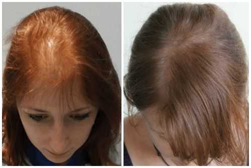 Генеролон: инструкция по применению спрея для волос и отзывы