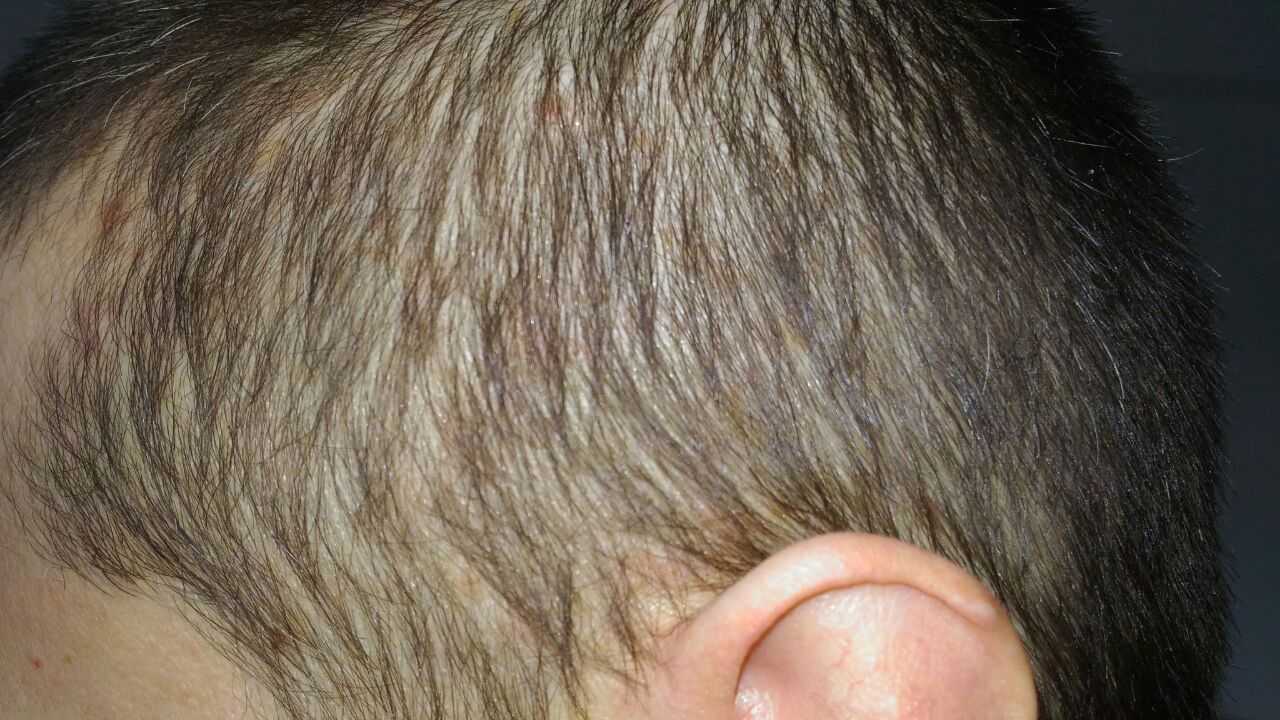 Лечение себорейного дерматита на волосистой части головы