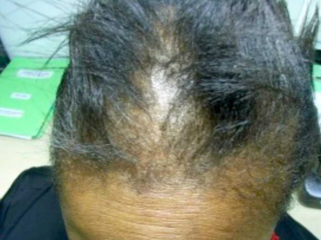 Какие лекарства вызывают выпадение волос