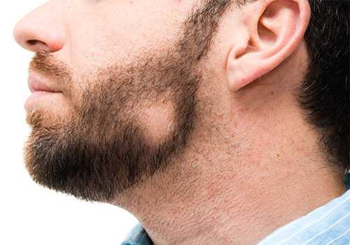 Алопеция у мужчин на бороде: причины, диагностика, лечение