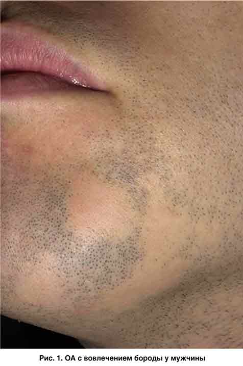 Алопеция бороды у мужчин причины