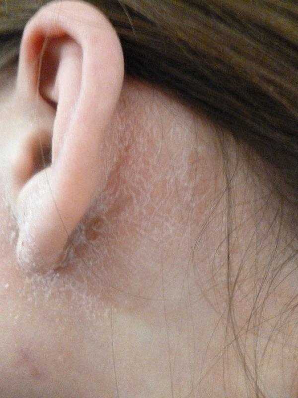 Перхоть в ушах: причины шелушения кожи, лечение, как избавиться от сухих корочек, белых хлопьев в ушной раковине, фото