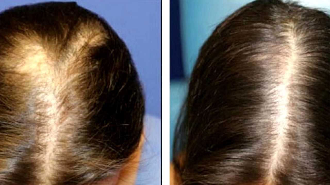 Дарсонваль для волос – панацея от всех проблем с волосами и кожей!