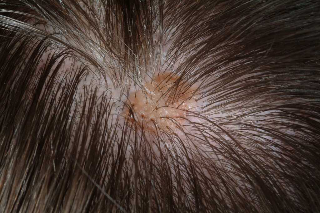 Экзема волосистой части головы у взрослых и детей