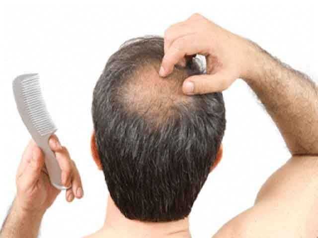 Как связан уровень дигидротестостерона с выпадением волос