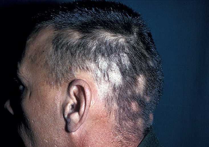 Алопеция: причины выпадения волос, лечение в зависимости от вида заболевания