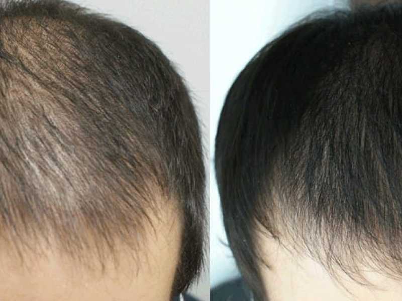 Инъекции для роста волос на голове: отзывы об уколах с , фото до и после, описание и виды процедуры, преимущества и недостатки метода, цена
