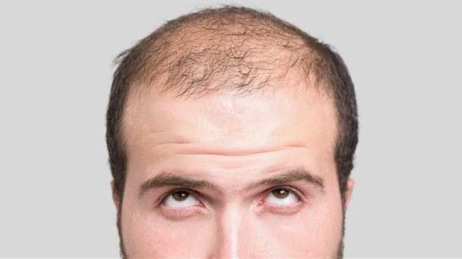 Роль гормонов и другие причины выпадения волос у мужчин