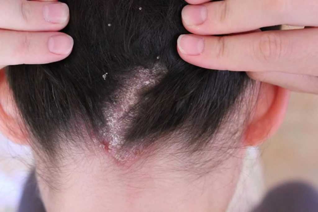 Как лечить себорейный дерматит волосистой части головы у взрослых и детей?