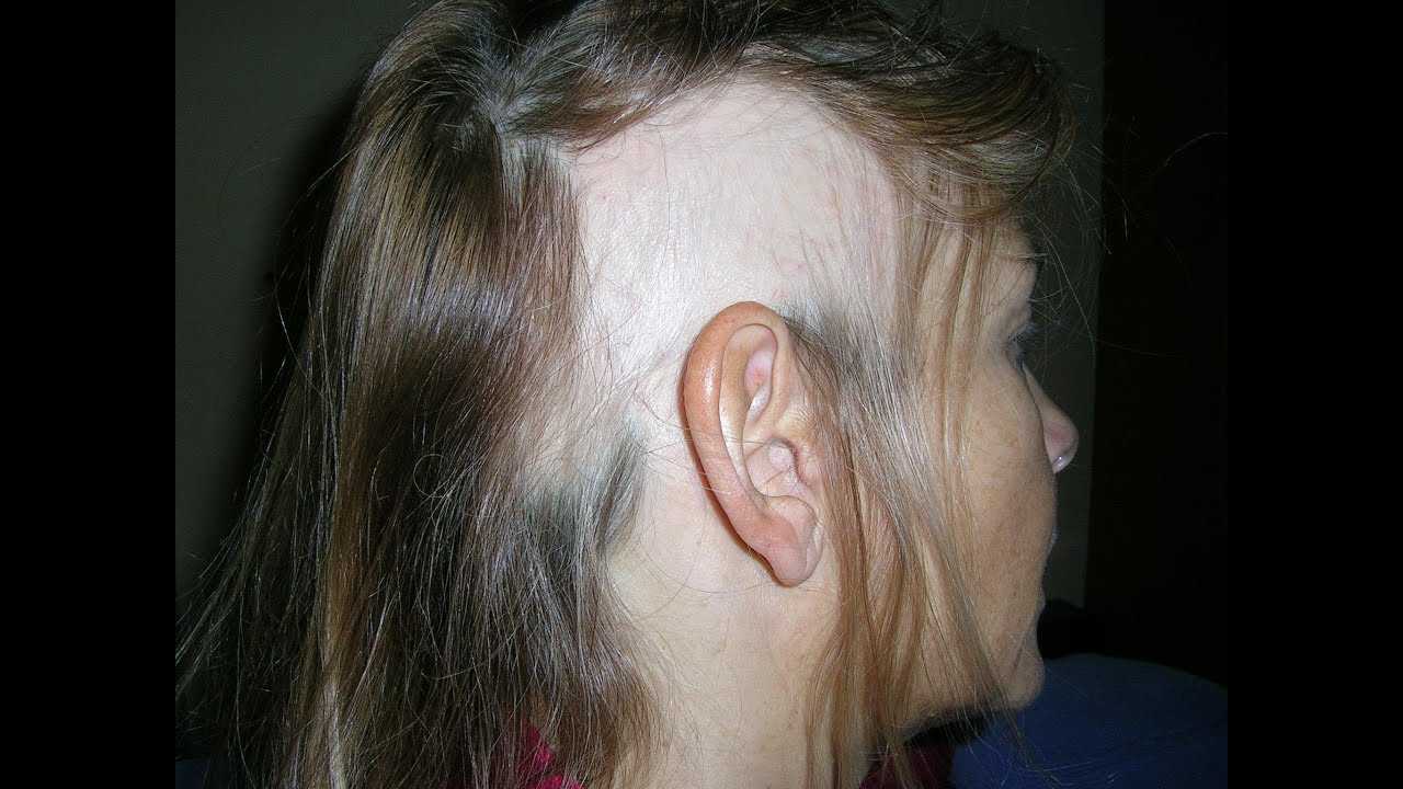 Через сколько вырастают волосы после лучевой терапии. как быстро проявляются побочные эффекты от лучевой терапии? при всех ли видах химиотерапии выпадают волосы