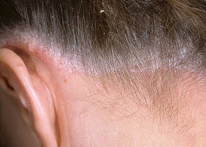 Как лечить корки на голове под волосами у взрослого?