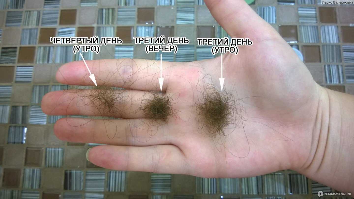 Норма выпадения волос в день — это сколько?