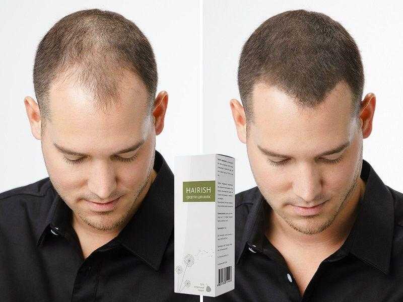 Средства от выпадения волос у мужчин. рейтинг лучших в аптеке, народные, шампуни, витамины. цены