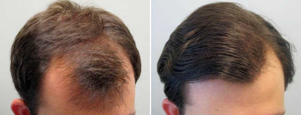 Топ-6 средств для восстановления волос у мужчин