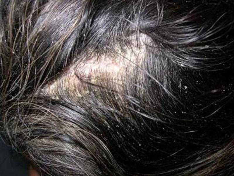 Как лечить себорею кожи на голове в домашних условиях?
