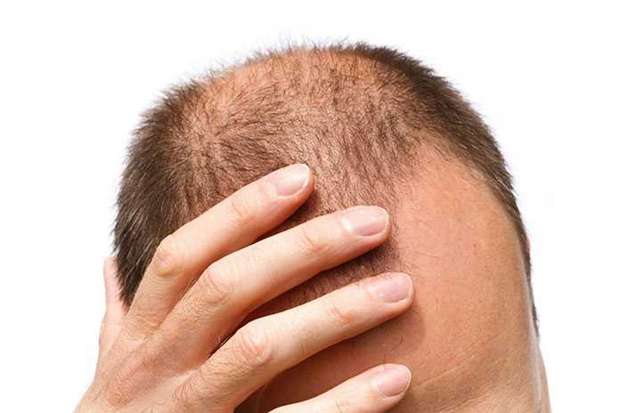 Что делать при выпадении волос во время стресса