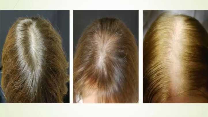 Алопеция: причины и лечение выпадения волос