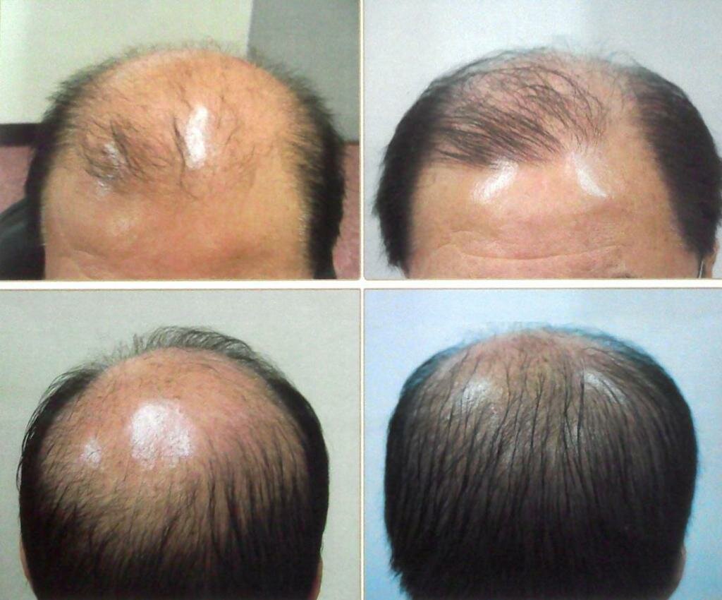Препараты с миноксидилом для волос: отзывы, инструкция, результаты. миноксидил миноксидил побочные эффекты отзывы
