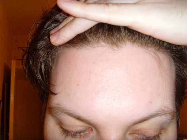 Короткие волоски на лбу. линия роста волос на лбу: что это такое и можно ли ее скорректировать