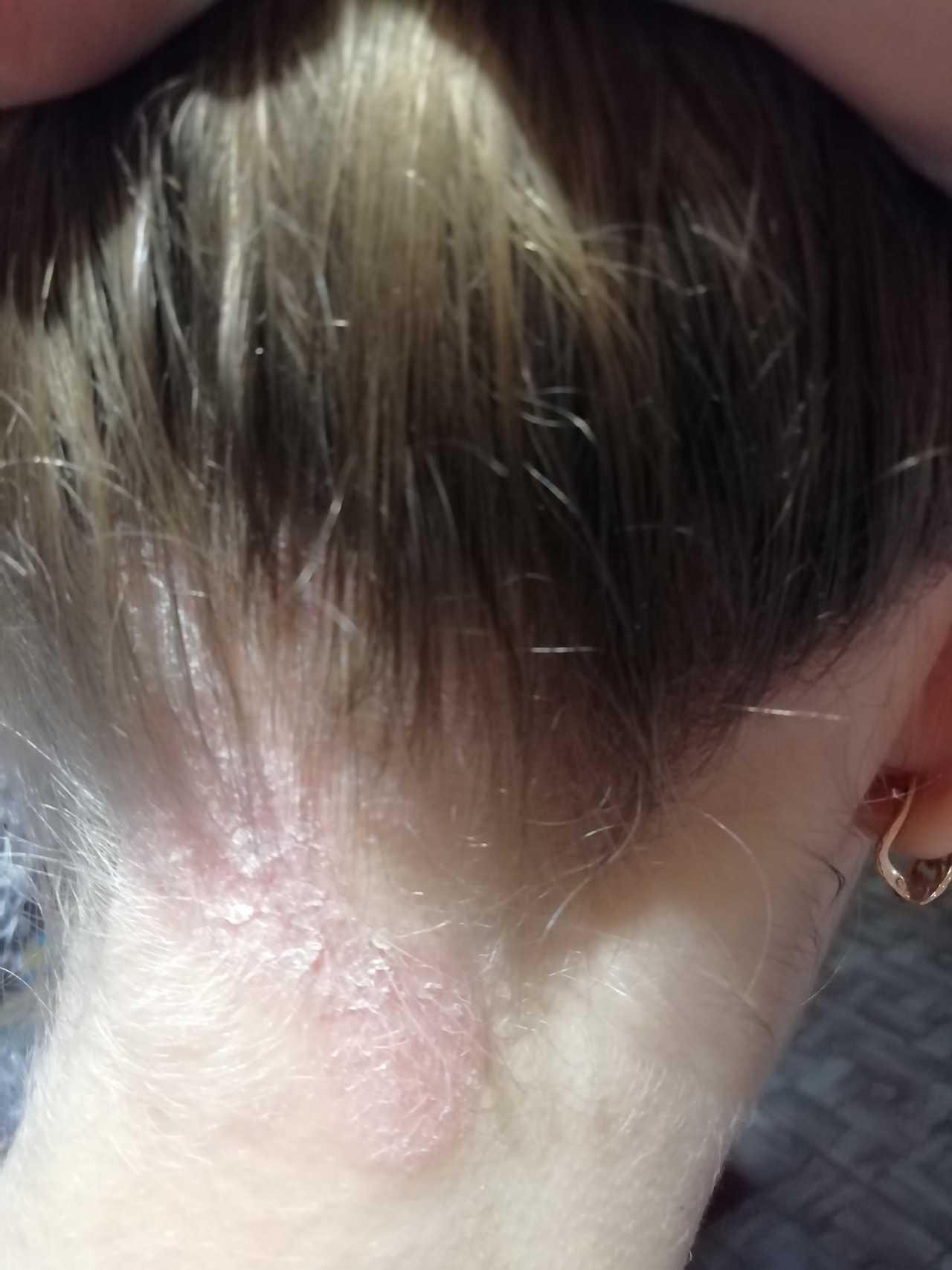 Лечение себорейного дерматита волосистой части головы