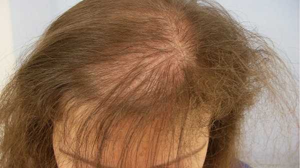 Пять причин, почему выпадают волосы, и как остановить их потерю