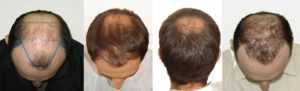 Скорость роста волос у мужчин: на голове и теле, средняя скорость в день, неделю, месяц, год , что влияет и чем стимулировать