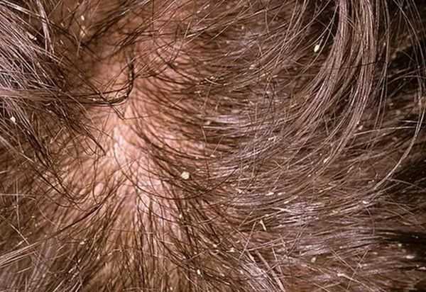Шелушение и образование корочек в ушах. причины и лечение перхоти и сухой кожи в ушах