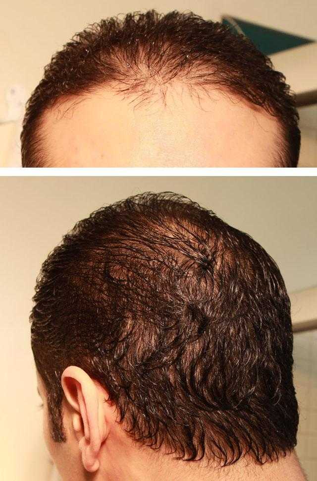 Средства против выпадения волос: обзор народных, косметических и медикаментозных препаратов