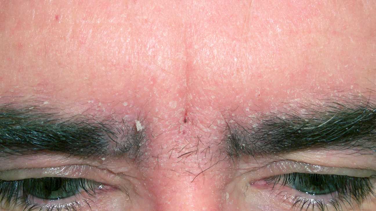 Себорея на лице — причины и методы лечения