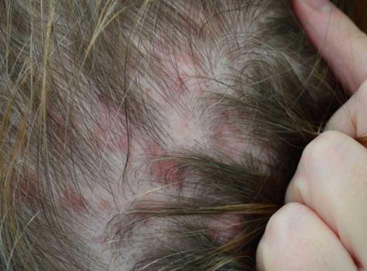Волосяной лишай на голове: фото различных видов (отрубевидный, красный), лечение, видео