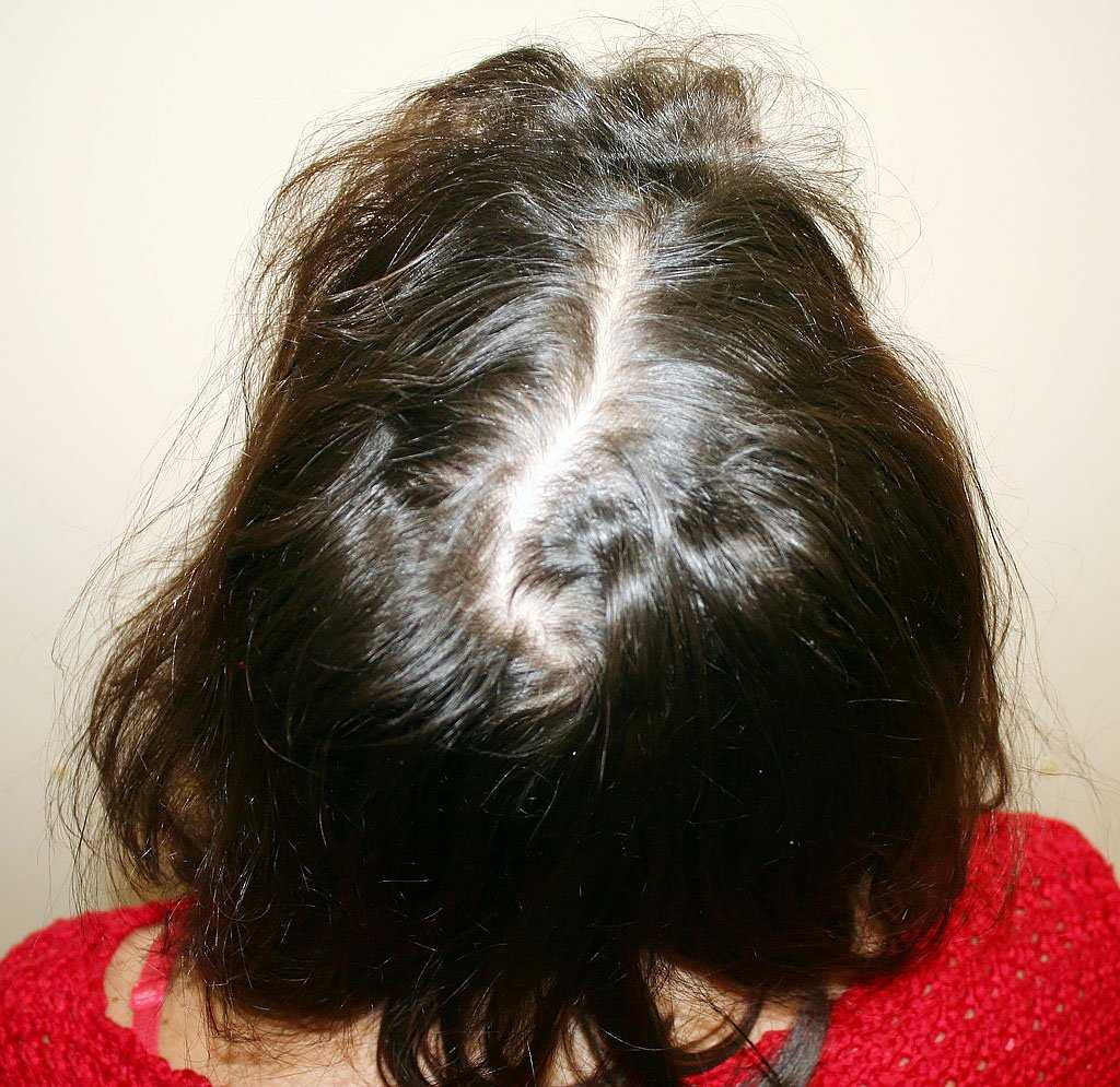 Склонность к осеннему выпадению волос