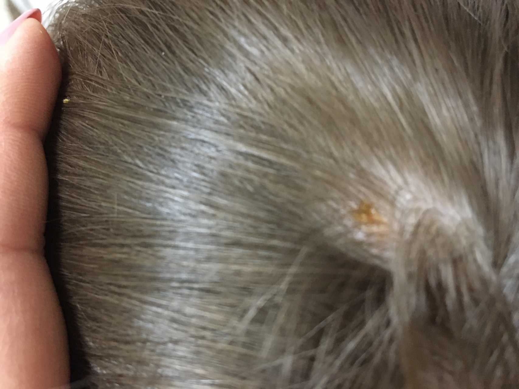 Причины и лечение болячек на голове в волосах, а также что делать с красными пятнами