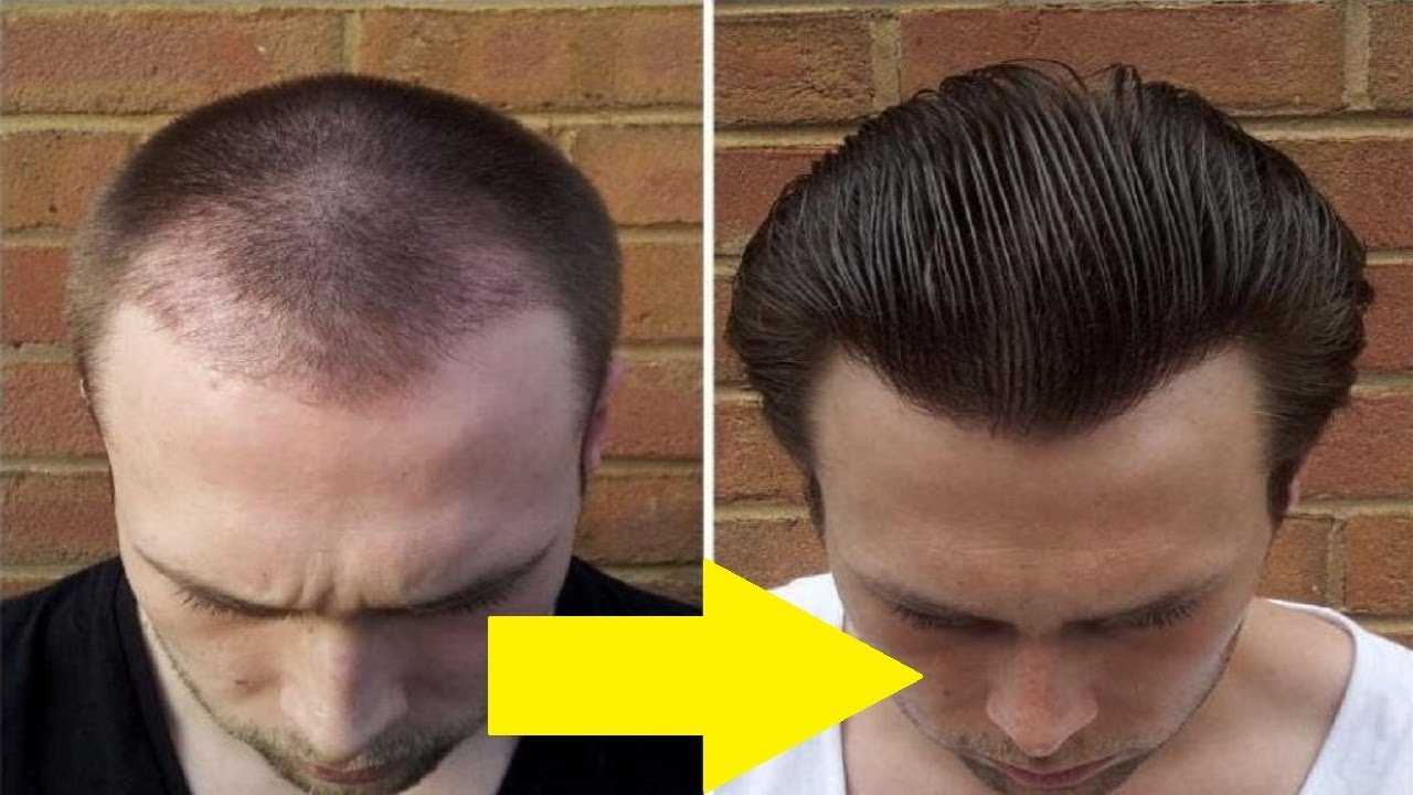 Сколько отрастают волосы у мужчин. Миноксидил 3%. Прически с залысинами. Миноксидил для волос на голове.