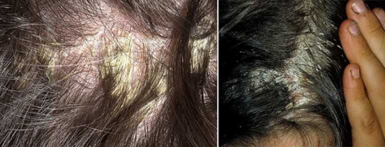 Симптомы и лечение проверенными способами себорейного дерматита на голове