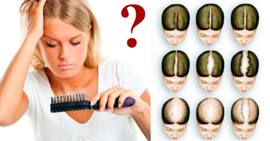 Выпадают волосы гормональное. Выпадение волос у женщин. Причины выпадения волос у женщин. Гормональные волосы на голове.