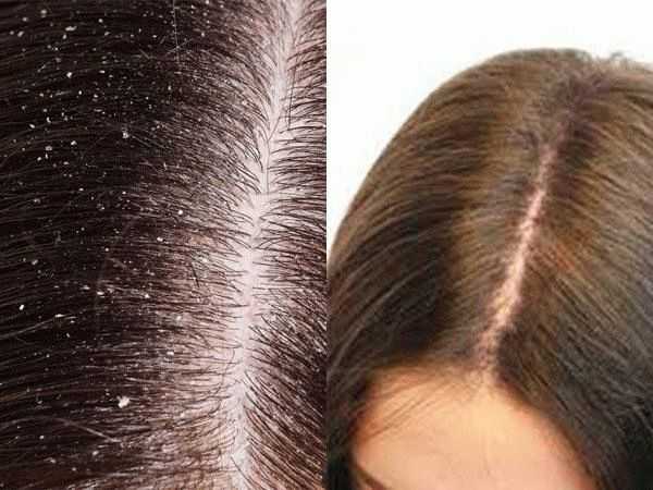 Дегтярное мыло помогает росту волос. как правильно мыть голову дегтярным мылом? дегтярный лосьон для роста волос.