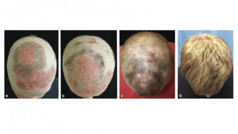 Основные внутренние и внешние причины выпадения волос