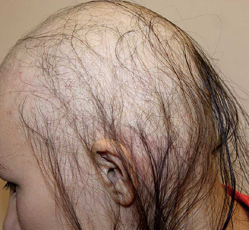 Алопеция — выпадение волос у женщин, симптомы, причины и лечение