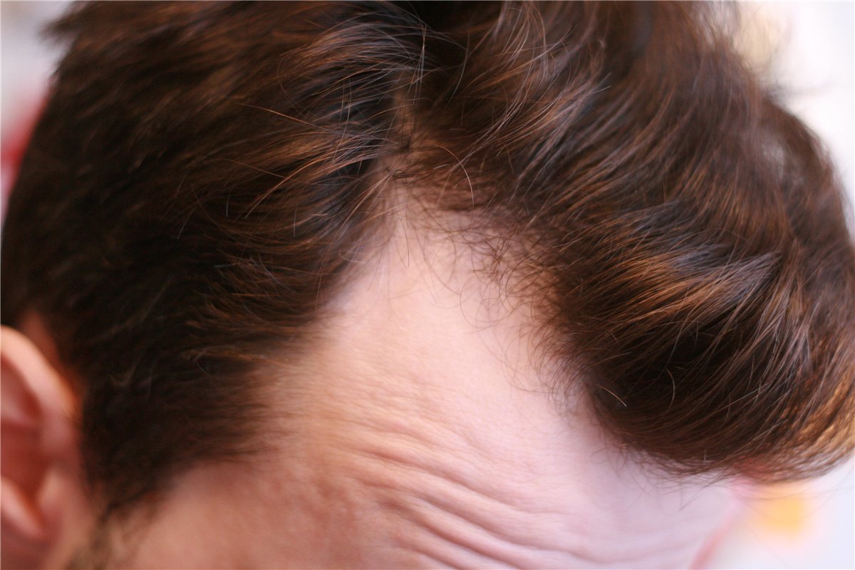 Лечение залысин и выпадения волос на лбу у мужчин
