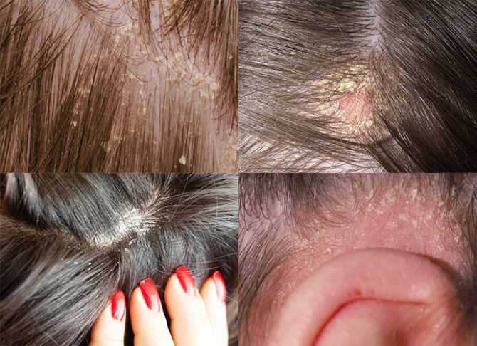 Эффективные методы борьбы с раздражением кожи головы и причины появления этой проблемы