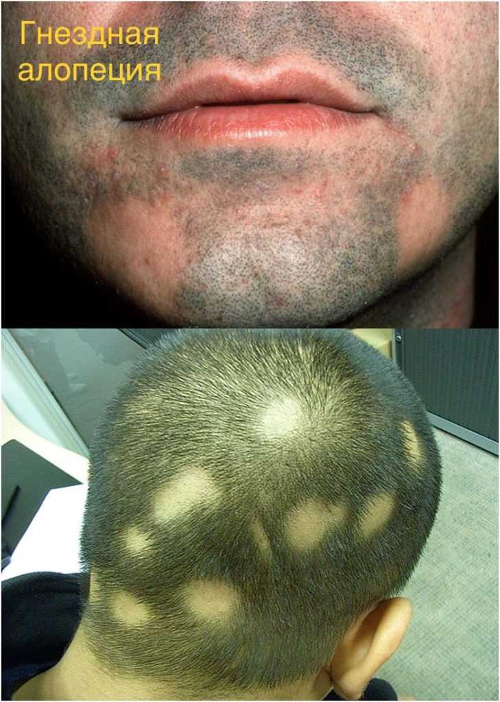 Алопеция на бороде у мужчин: как лечить выпадение волос, облысение и проплешины на подбородке, причины, профилактика