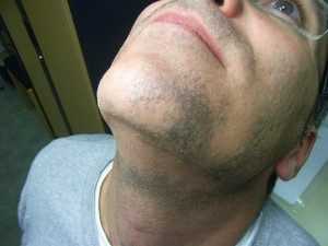 Алопеция бороды у мужчин: лечение и причины заболевания