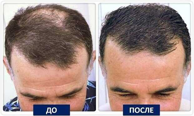 Средства для восстановления волос у мужчин: обзор 8 лучших