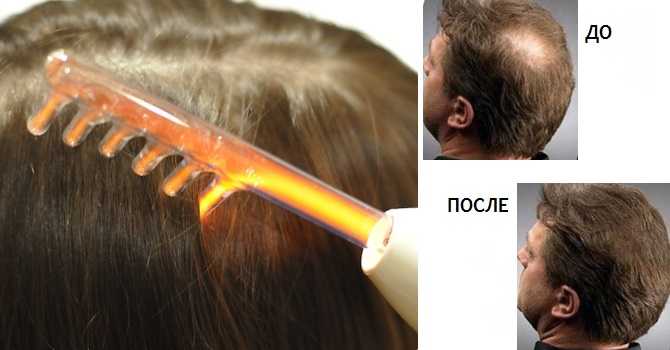 Дарсонваль для роста волос и лечения кожи головы