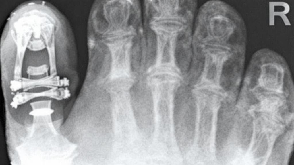 SHEVRON-остеотомия: как избавиться от «косточки» на большом пальце стопы