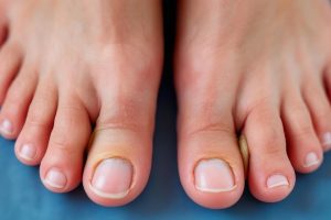 SHEVRON-остеотомия: как избавиться от «косточки» на большом пальце стопы