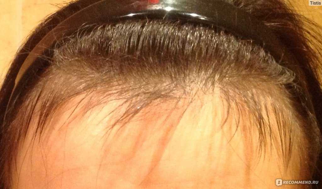 Почему не растут волосы и как гомеопатия помогает решить проблему. что делать если не растут волосы на голове: возможные причины и способы исправления